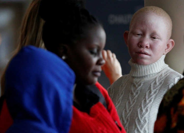 South Africa Albinism